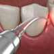 The Link Between Gum Disease and Heart Disease